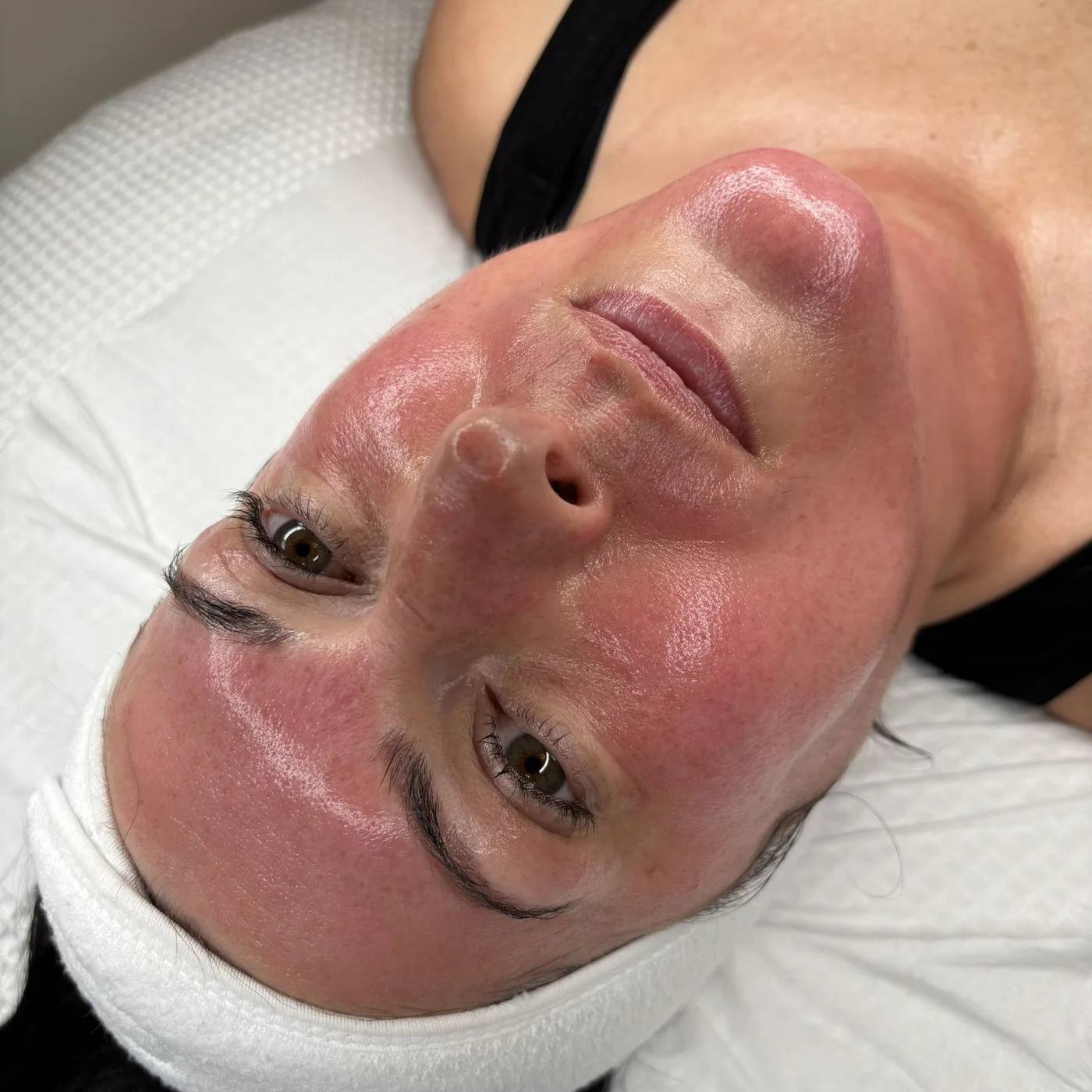 A facial result shared by Natural Glaze Skin Clinic