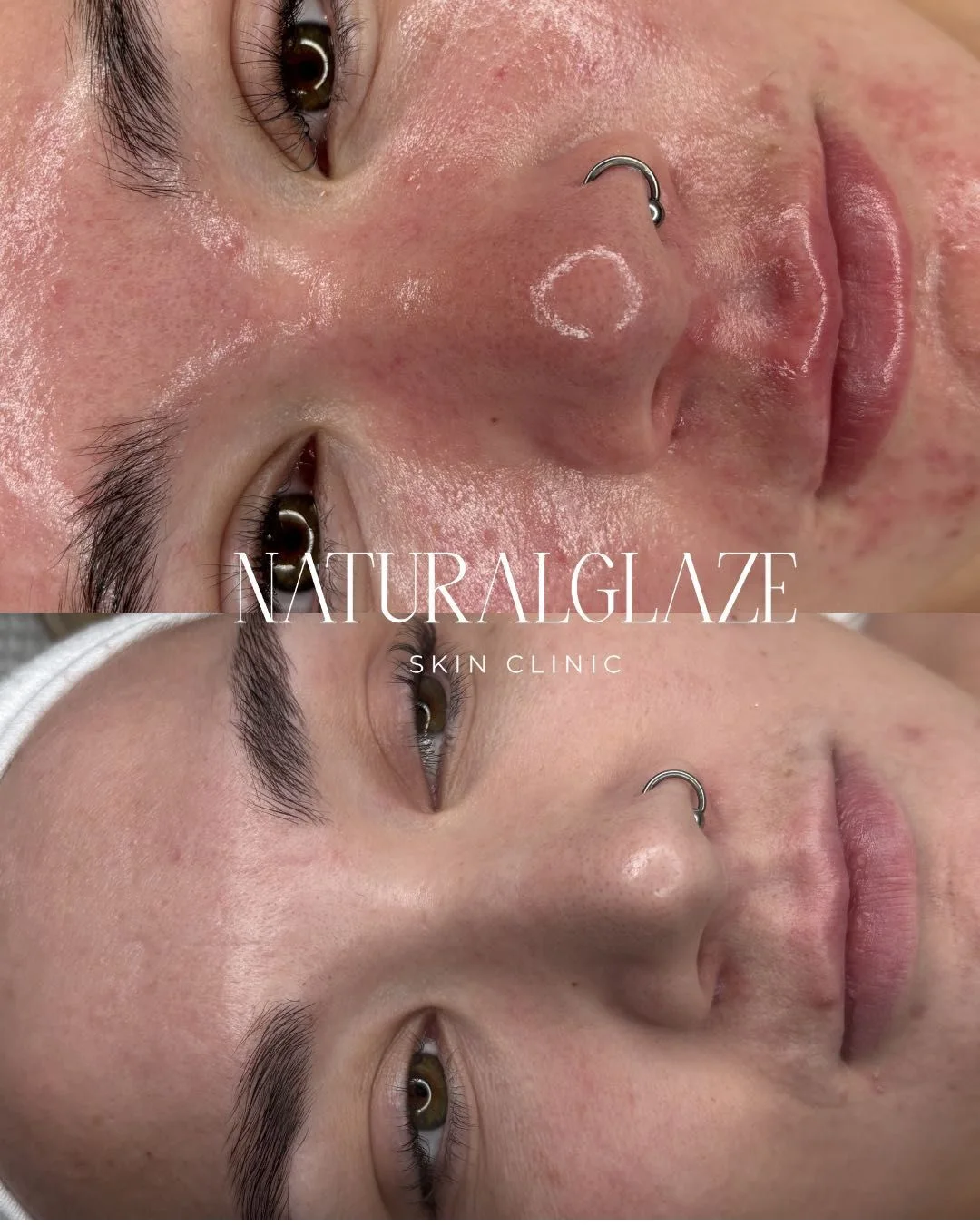 A facial comparison shared by Natural Glaze Skin Clinic