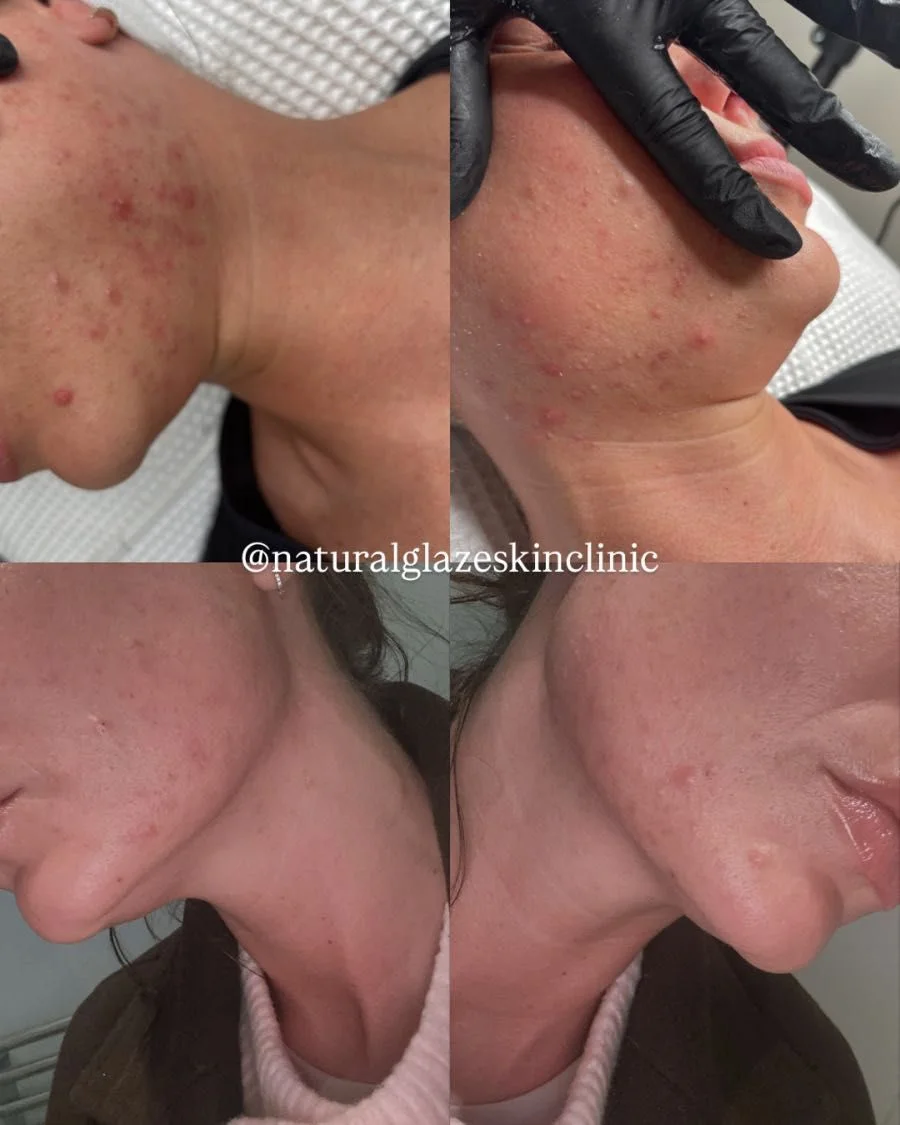 Four views documenting an acne treatment journey