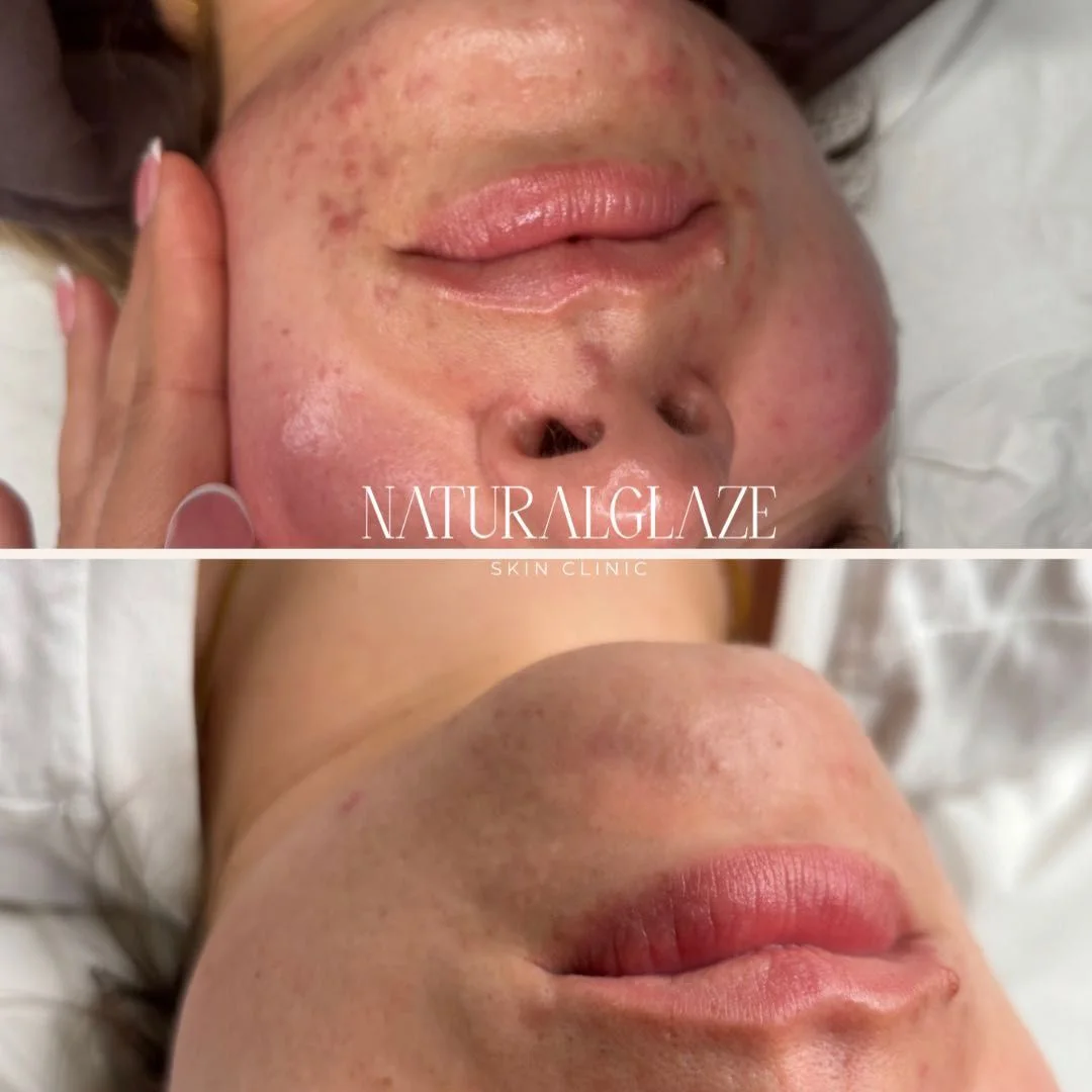 A skin treatment comparison from the clinic